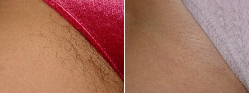 Hair Removal In North Wales The Laser Clinic