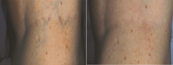 laser vein removal